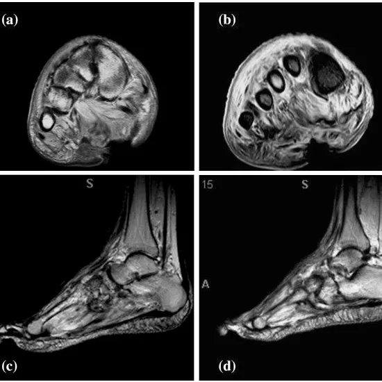 MRI Foot With Contrast